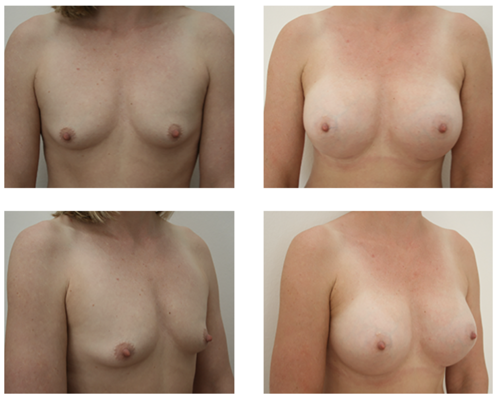Brystoperation før og efter billede