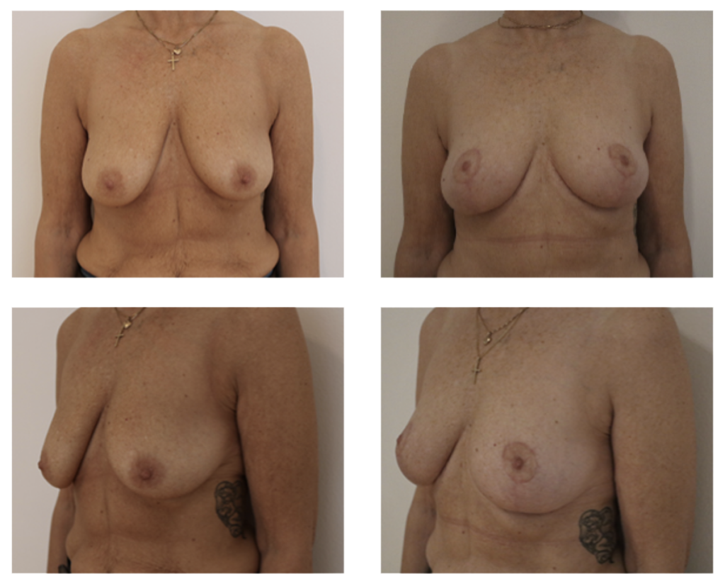 Brystoperation før og efter billede