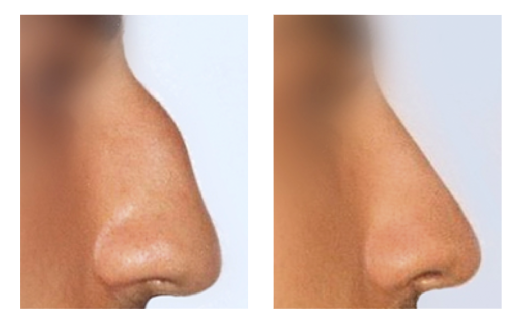 næsekirurgi før og efter billede