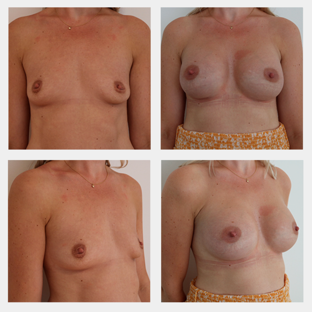 før og efter billede af brystforstørrelse