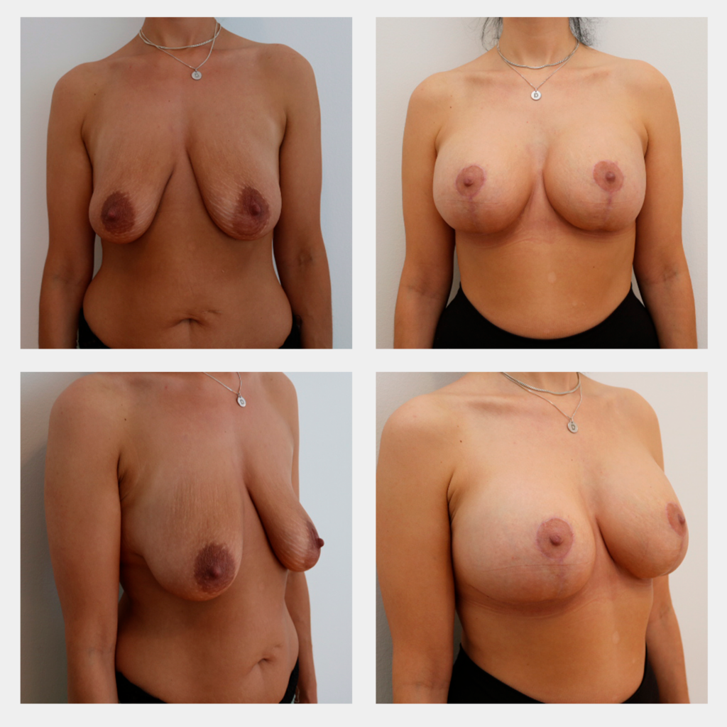 Brystoperation HCA-Klinikken