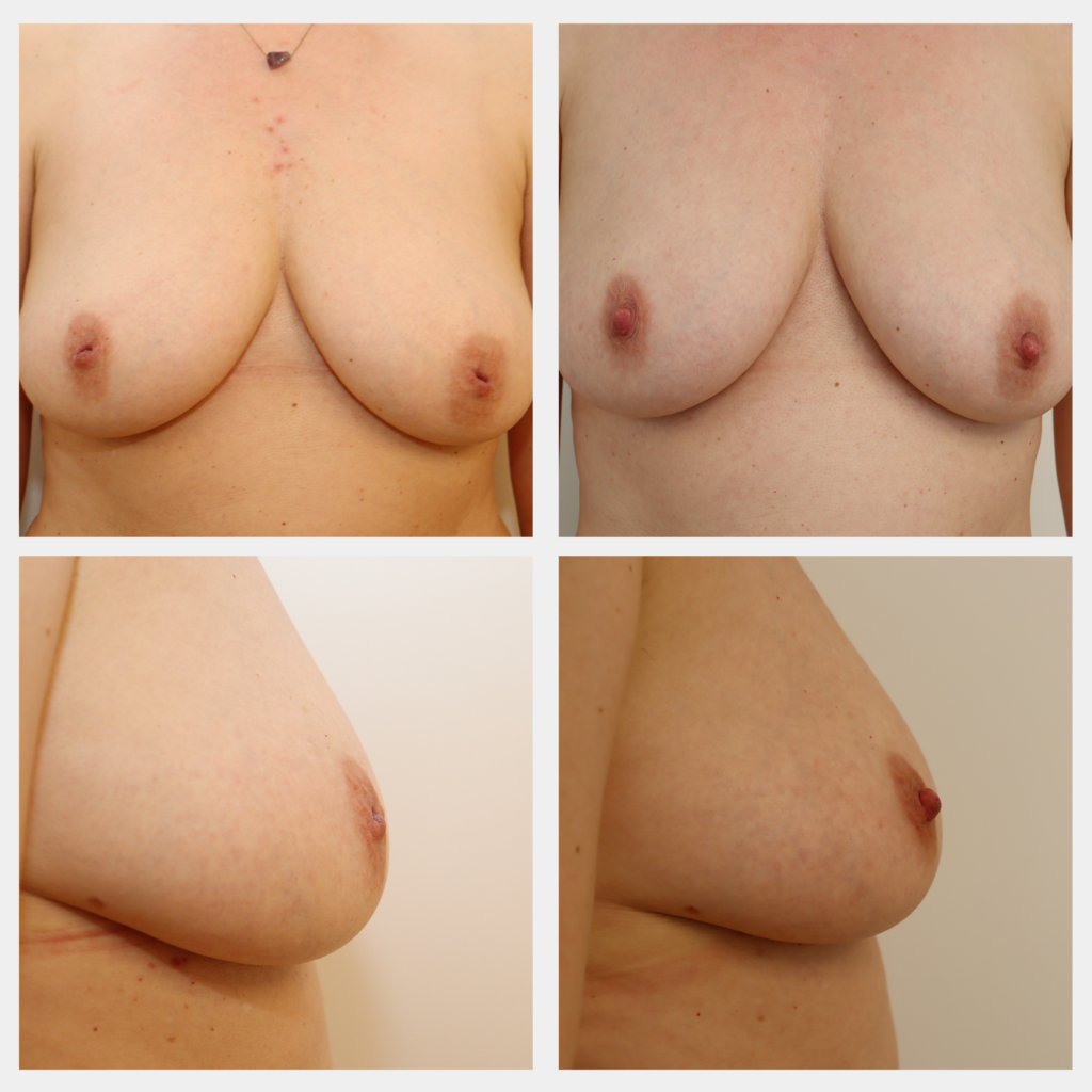 Før og efter billede: Korrektion af indadvendte brystvorter